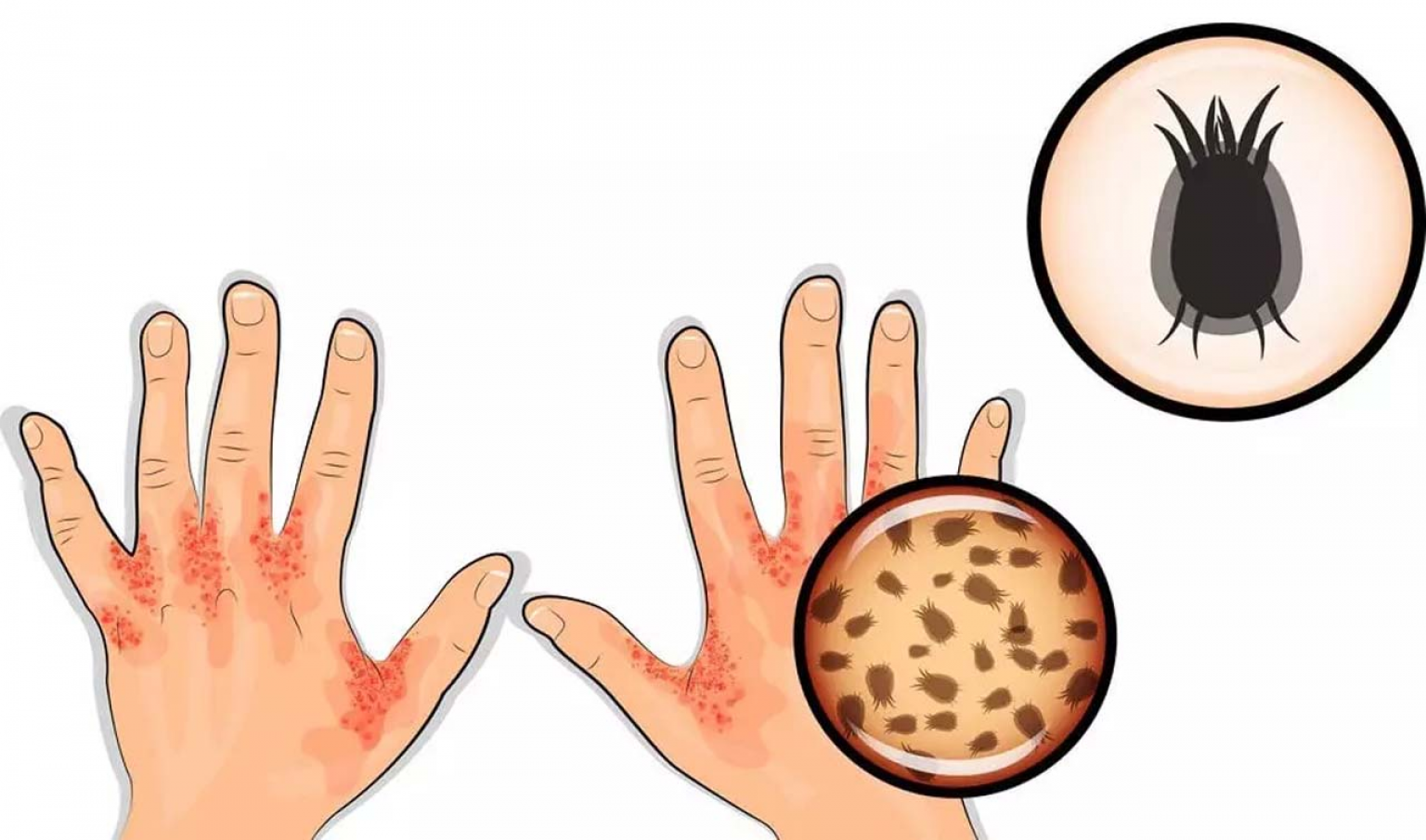 How Long Can Scabies Live In A Mattress Professional Guide